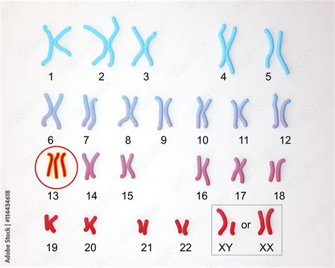 Patau Syndrome Karyotype Male Or Female Labeled Trisomy 13 3d Illustration Illustration