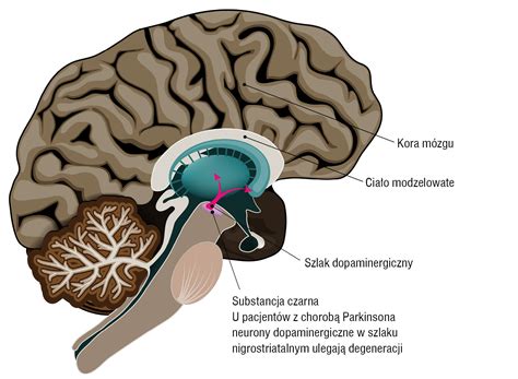 Neurologia Po Dyplomie Choroba Parkinsona