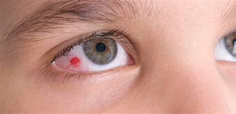 Symptoms Types And Causes Of Eye Infections