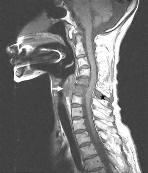 Peripheral T Cell Lymphoma Of Cervical Spine