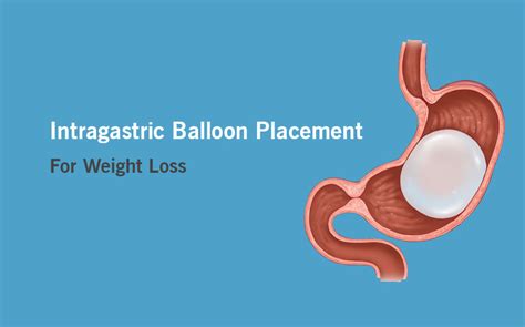 Intragastric Balloon Placement For Weight Loss Keyhole Clinic Kochi