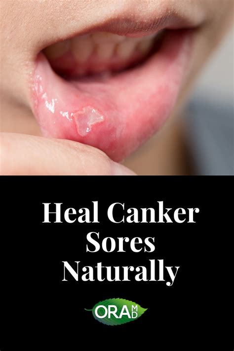 Canker Sores And How To Treat Them Canker Sore Heal Canker Sore Cankers
