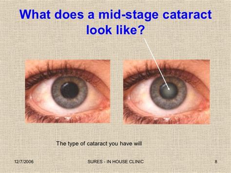 How Quickly Do Cataracts Develop