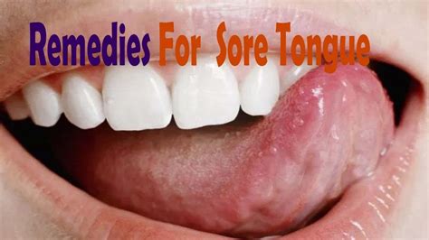 5 Effective And Easy Home Remedies For A Sore Tongue Youtube