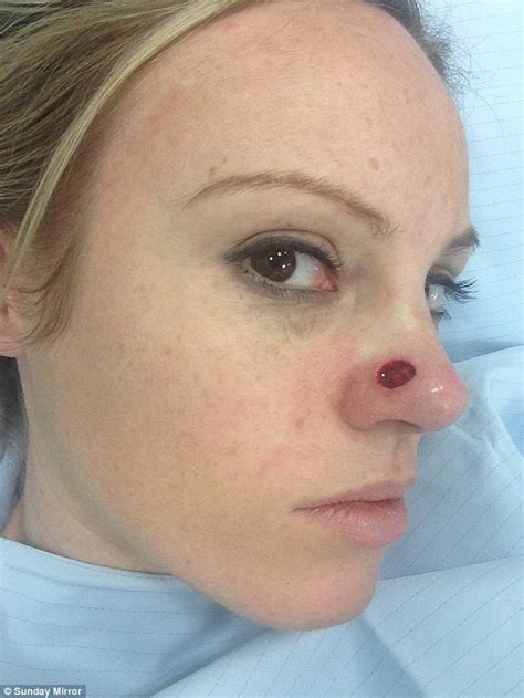 Basal Cell Carcinoma Nose Before After Pictures