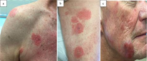 A Erythematous Scaly Plaques Present On Doubly Covered Areas