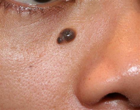 Photos Of Moles On Face And Neck How To Remove Moles Warts Skin