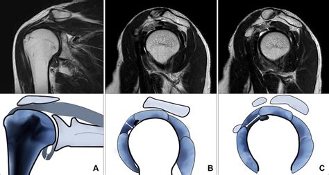 A Capsular Thickness In The Axillary Recess Is Measured At The Thickest