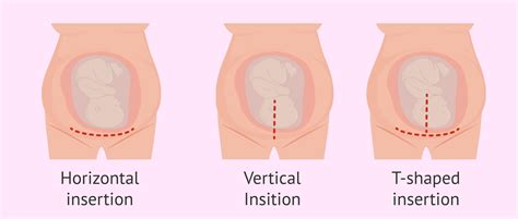 Cesarean Section How Is It Performed And What Care Is Needed