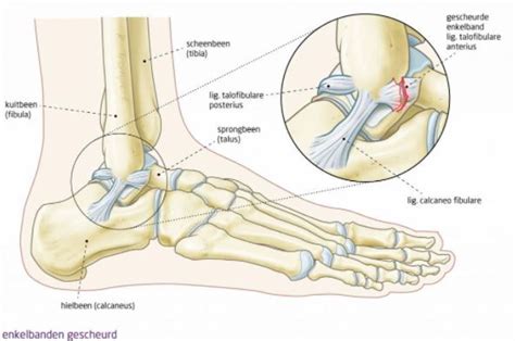 Ankle Brace For Torn Ankle Ligaments Probrace