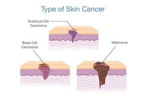 How To Detect The Different Types Of Skin Cancer Jupiter Dermatology