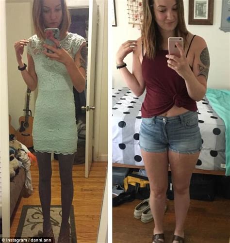 Eating Disorder Sufferer Shares Before And After Snaps