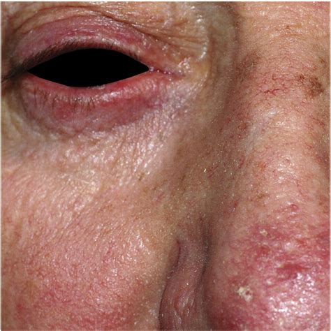 Rosacea And Rhinophyma Clinics In Dermatology