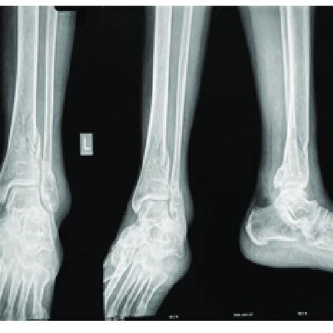 Radiograph Showing Left Distal Tibia Fibula Fracture In Download