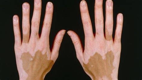 Apa Penyebab Penyakit Vitiligo Dan Kondisi Penderita