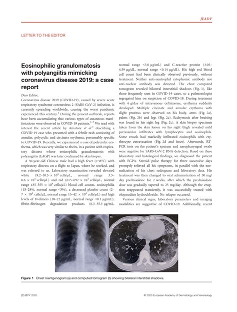 Pdf Eosinophilic Granulomatosis With Polyangiitis Mimicking Covid‐19