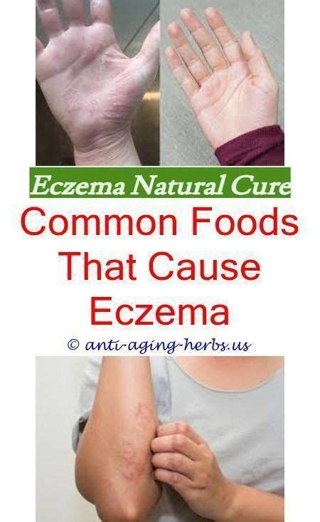 Pin On Best Eczema Treatment For Adults