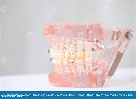 Mock Teeth With Braces Demonstration Model Of Teeth Editorial Image