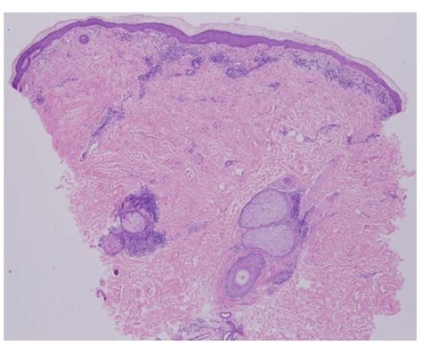 Skin Biopsy Of Plaque On The Chest Histopathology Displays An