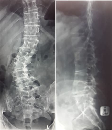 Illustrative Example Pre Operative Postero Anterior Radiograph Showing