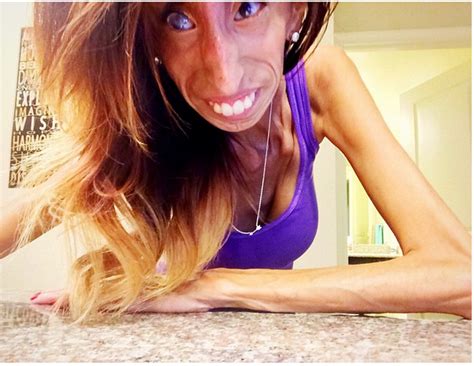 Health Disease And Treatment Lizzie Velasquez Stands Against Bullying