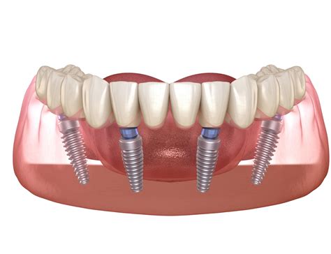 Dental Implants 101 Everything You Need To Know The Pink Velvet Blog