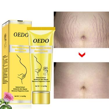 Moms With Stretch Marks And Abs Best Stretch Mark Cream