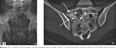 Figure 1 From Osteoblastoma In The Sacrum A Case Report Semantic Scholar