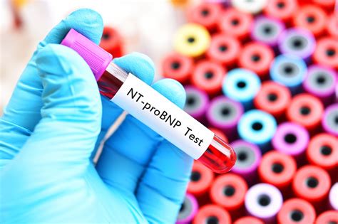 Looking for online definition of nt or what nt stands for? Prognostic Implications of NT-proBNP Levels in Heart ...