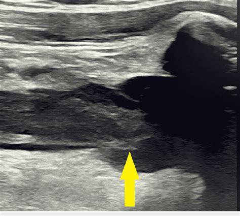 Ultrasound Of Right Brachiocephalic Vein With Thrombus Arrow