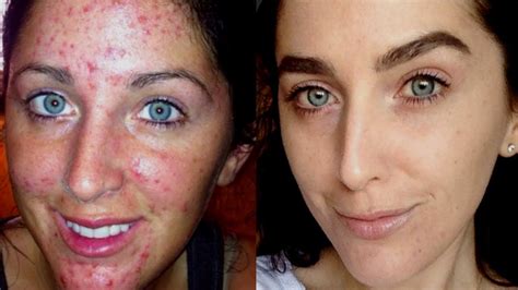 My Acne Story And How I Cleared My Skin Youtube