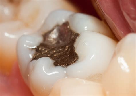 Replacement Of Amalgam Fillings Dp Dental