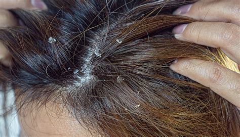 What Is Seborrhoeic Dermatitis Fulham Scalp And Hair Clinic