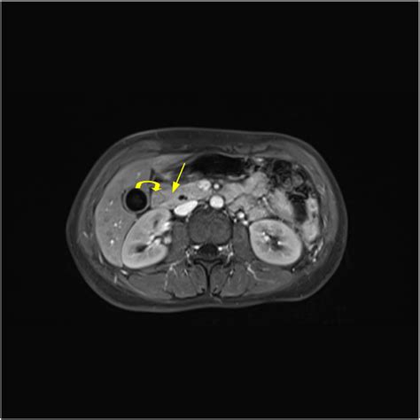 Investigation Of Annular Pancreas Through Multiple Detector Spiral Ct