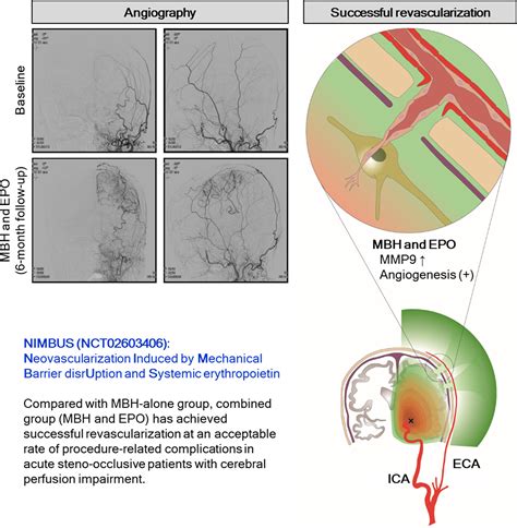 Transdural Revascularization By Multiple Burrhole After Erythropoietin