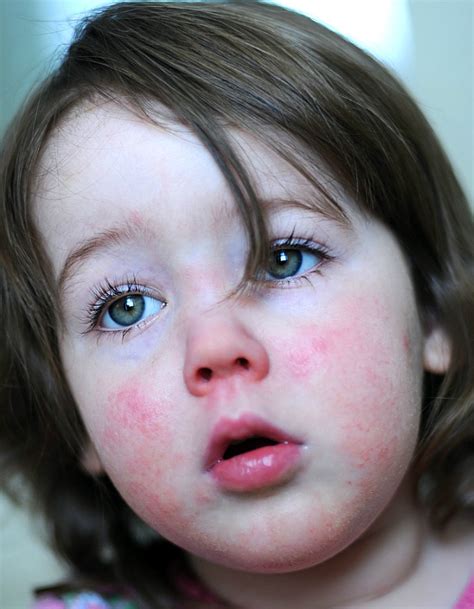 Parents Warned Over Rise In Scarlet Fever Cases In Cheshire Nantwich News