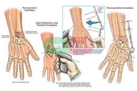 Open Reduction with Internal and External Fixation of ...