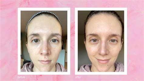 How To Treat Acne Uneven Texture And Large Pores Allure