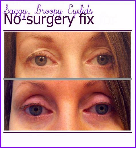 How To Get Rid Of Droopy Eyelids Without Surgery