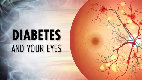 Diabetic Eye Disease Eye Health Complications Of Diabetes