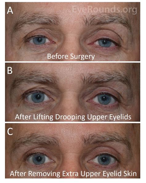 Atlas Entry Cosmetic Correction Of Secondary Upper Eyelid