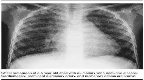 Pulmonary Veno Occlusive Disease Current Opinion In Pulmonary Medicine