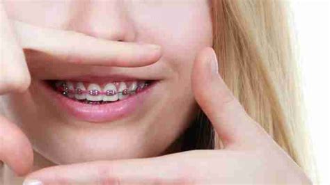 Cost Of Braces For Kids How Much Do Braces Cost