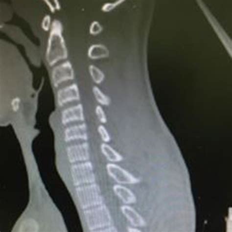 Ct Cervical Spine Sagittal Reformatted Image Reveal Straightening Of