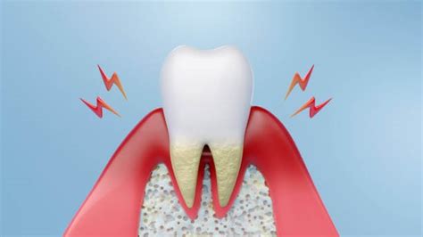Effective Ways To Reverse Periodontal Disease Naturally