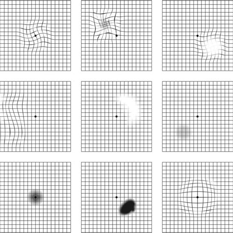 Grid chart for macular degeneration