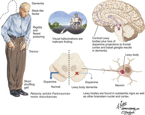 Dementia With Lewy Bodies Including Parkinsons Disease Dementia
