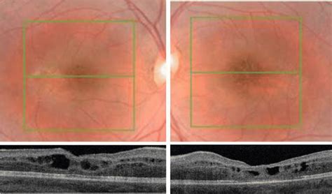 Fundus Photography And Structural Optical Coherence Tomography B Scan