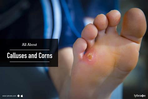 All About Calluses And Corns By Dr Rashmi Mittal Lybrate