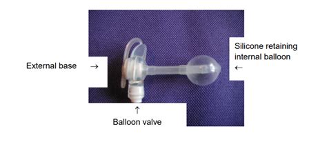 Low Profile Balloon Retained Gastrostomy Tubes Cuh